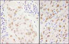 SP1 Antibody - Detection of Human and Mouse SP1 by Immunohistochemistry. Sample: FFPE sections of human breast carcinoma (left) and mouse squamous cell carcinoma (right). Antibody: Affinity purified rabbit anti-Sp1 used at a dilution of 1:1000 (1 ug/ml). Detection: DAB.