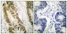 SP1 Antibody - Immunohistochemistry analysis of paraffin-embedded human colon carcinoma tissue, using SP1 Antibody. The picture on the right is blocked with the synthesized peptide.