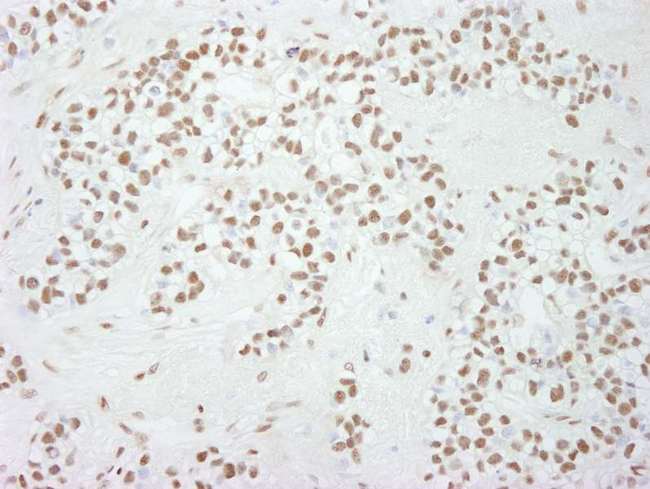 SP1 Antibody - Detection of Human Sp1 by Immunohistochemistry. Sample: FFPE section of human breast carcinoma. Antibody: Affinity purified rabbit anti-Sp1 used at a dilution of 1:250.