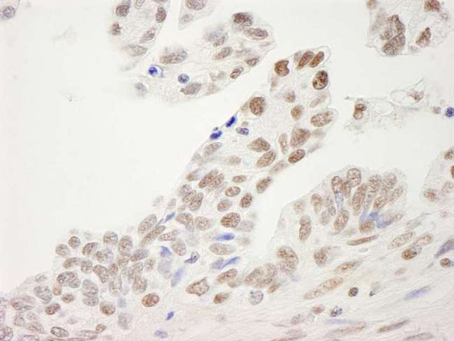 SP1 Antibody - Detection of Human Sp1 by Immunohistochemistry. Sample: FFPE section of human ovarian carcinoma. Antibody: Affinity purified rabbit anti-Sp1 used at a dilution of 1:250.