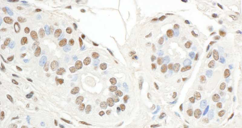 SP1 Antibody - Detection of Human SP1 by Immunohistochemistry. Sample: FFPE section of human breast carcinoma. Antibody: Affinity purified rabbit anti-SP1 used at a dilution of 1:5000 (0.2 Detection: DAB.