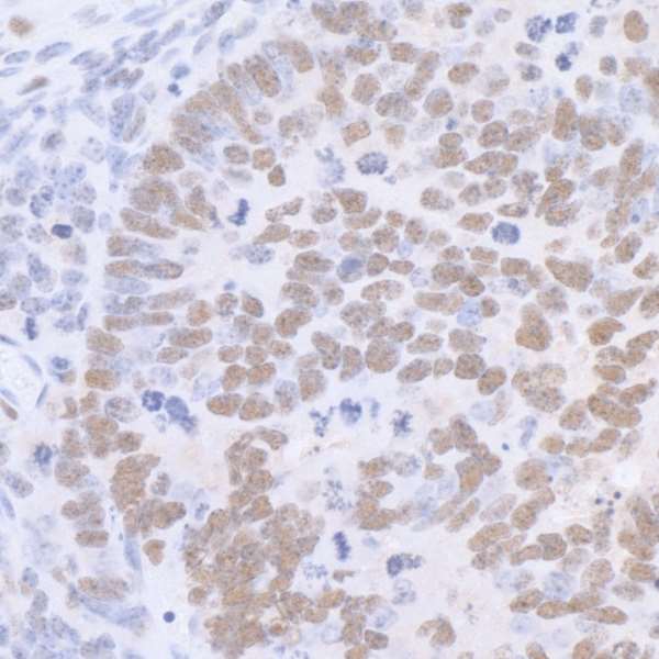 SP1 Antibody - Detection of mouse SP1 by immunohistochemistry. Sample: FFPE section of mouse renal cell carcinoma. Antibody: Affinity purified rabbit anti-SP1 used at a dilution of 1:5,000 (0.2µg/ml). Detection: DAB