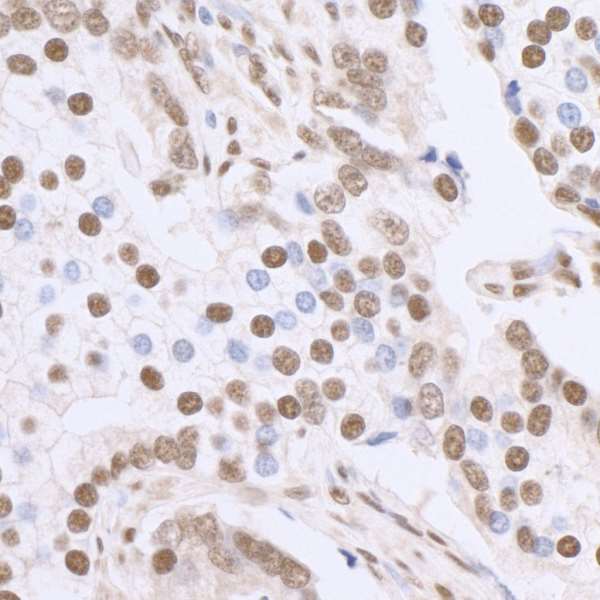 SP1 Antibody - Detection of human SP1 by immunohistochemistry. Sample: FFPE section of human breast carcinoma. Antibody: Affinity purified rabbit anti-SP1 used at a dilution of 1:5,000 (0.2µg/ml). Detection: DAB