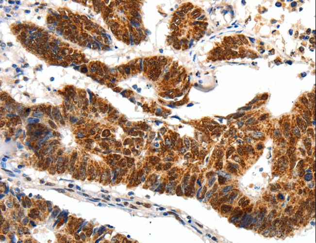 SP1 Antibody - Immunohistochemistry of paraffin-embedded Human ovarian cancer using SP1 Polyclonal Antibody at dilution of 1:40.