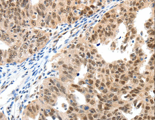 SP1 Antibody - Immunohistochemistry of paraffin-embedded Human ovarian cancer using SP1 Polyclonal Antibody at dilution of 1:40.