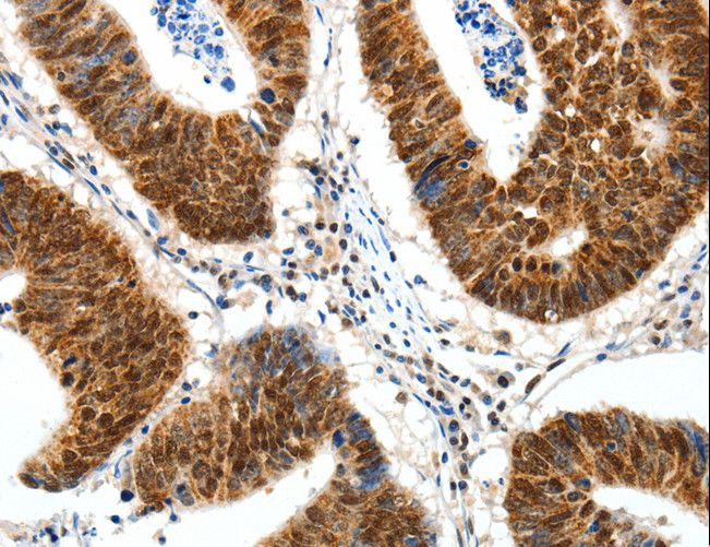 SP1 Antibody - Immunohistochemistry of paraffin-embedded Human ovarian cancer using SP1 Polyclonal Antibody at dilution of 1:30.