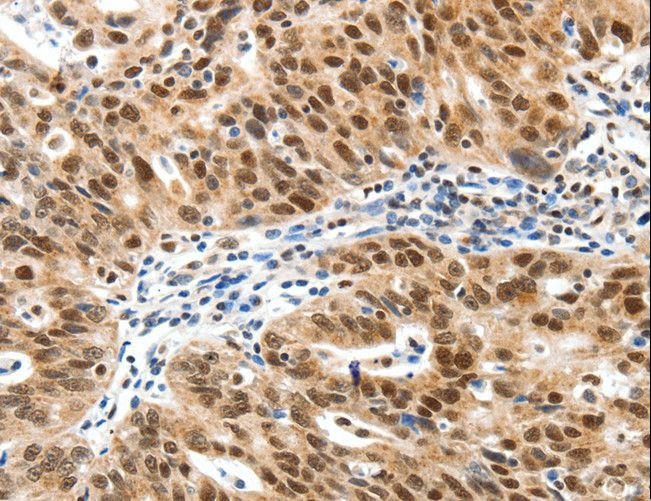 SP1 Antibody - Immunohistochemistry of paraffin-embedded Human ovarian cancer using SP1 Polyclonal Antibody at dilution of 1:30.