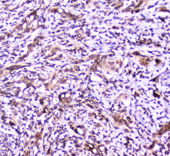 SP1 Antibody - IHC analysis of SP1 using anti-SP1 antibody. SP1 was detected in paraffin-embedded section of human intestinal cancer tissue. Heat mediated antigen retrieval was performed in citrate buffer (pH6, epitope retrieval solution) for 20 mins. The tissue section was blocked with 10% goat serum. The tissue section was then incubated with 2µg/ml rabbit anti-SP1 Antibody overnight at 4°C. Biotinylated goat anti-rabbit IgG was used as secondary antibody and incubated for 30 minutes at 37°C. The tissue section was developed using Strepavidin-Biotin-Complex (SABC) with DAB as the chromogen.