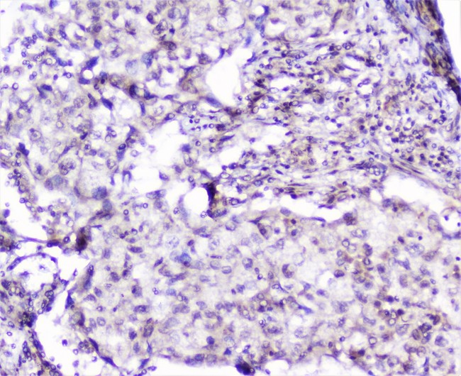 SP1 Antibody - IHC analysis of SP1 using anti-SP1 antibody. SP1 was detected in paraffin-embedded section of human lung cancer tissue. Heat mediated antigen retrieval was performed in citrate buffer (pH6, epitope retrieval solution) for 20 mins. The tissue section was blocked with 10% goat serum. The tissue section was then incubated with 2µg/ml rabbit anti-SP1 Antibody overnight at 4°C. Biotinylated goat anti-rabbit IgG was used as secondary antibody and incubated for 30 minutes at 37°C. The tissue section was developed using Strepavidin-Biotin-Complex (SABC) with DAB as the chromogen.