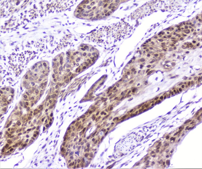 SP1 Antibody - IHC analysis of SP1 using anti-SP1 antibody. SP1 was detected in paraffin-embedded section of human oesophagus squama cancer tissue. Heat mediated antigen retrieval was performed in citrate buffer (pH6, epitope retrieval solution) for 20 mins. The tissue section was blocked with 10% goat serum. The tissue section was then incubated with 2µg/ml rabbit anti-SP1 Antibody overnight at 4°C. Biotinylated goat anti-rabbit IgG was used as secondary antibody and incubated for 30 minutes at 37°C. The tissue section was developed using Strepavidin-Biotin-Complex (SABC) with DAB as the chromogen.