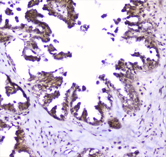 SP1 Antibody - IHC analysis of SP1 using anti-SP1 antibody. SP1 was detected in paraffin-embedded section of human ovary cancer tissue. Heat mediated antigen retrieval was performed in citrate buffer (pH6, epitope retrieval solution) for 20 mins. The tissue section was blocked with 10% goat serum. The tissue section was then incubated with 2µg/ml rabbit anti-SP1 Antibody overnight at 4°C. Biotinylated goat anti-rabbit IgG was used as secondary antibody and incubated for 30 minutes at 37°C. The tissue section was developed using Strepavidin-Biotin-Complex (SABC) with DAB as the chromogen.