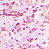 SP1 Antibody - Immunohistochemical analysis of SP1 (pT453) staining in human breast cancer formalin fixed paraffin embedded tissue section. The section was pre-treated using heat mediated antigen retrieval with sodium citrate buffer (pH 6.0). The section was then incubated with the antibody at room temperature and detected using an HRP-conjugated compact polymer system. DAB was used as the chromogen. The section was then counterstained with hematoxylin and mounted with DPX.