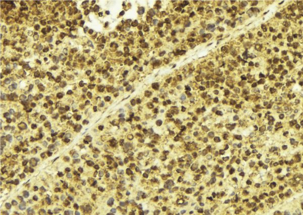 SP100 Antibody - 1:100 staining human breast carcinoma tissue by IHC-P. The sample was formaldehyde fixed and a heat mediated antigen retrieval step in citrate buffer was performed. The sample was then blocked and incubated with the antibody for 1.5 hours at 22°C. An HRP conjugated goat anti-rabbit antibody was used as the secondary.