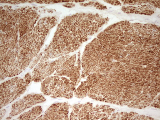 SP110 Antibody - Immunohistochemical staining of paraffin-embedded Carcinoma of Human bladder tissue using anti-SP110 mouse monoclonal antibody. (Heat-induced epitope retrieval by 1 mM EDTA in 10mM Tris, pH8.5, 120C for 3min,