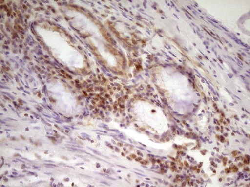 SP110 Antibody - Immunohistochemical staining of paraffin-embedded Carcinoma of Human lung tissue using anti-SP110 mouse monoclonal antibody. (Heat-induced epitope retrieval by 1 mM EDTA in 10mM Tris, pH8.5, 120C for 3min,