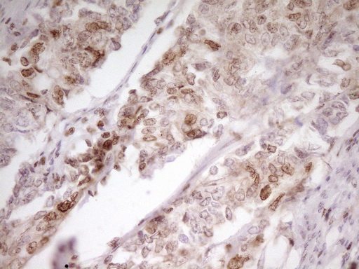 SP110 Antibody - Immunohistochemical staining of paraffin-embedded Adenocarcinoma of Human endometrium tissue using anti-SP110 mouse monoclonal antibody. (Heat-induced epitope retrieval by 1 mM EDTA in 10mM Tris, pH8.5, 120C for 3min,