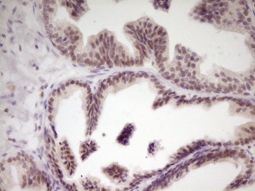 SP110 Antibody - Immunohistochemical staining of paraffin-embedded Carcinoma of Human prostate tissue using anti-SP110 mouse monoclonal antibody. (Heat-induced epitope retrieval by 1 mM EDTA in 10mM Tris, pH8.5, 120C for 3min,