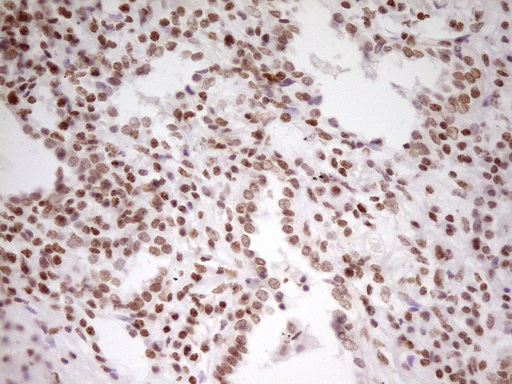 SP110 Antibody - Immunohistochemical staining of paraffin-embedded Carcinoma of Human lung tissue using anti-SP110 mouse monoclonal antibody. (Heat-induced epitope retrieval by 1 mM EDTA in 10mM Tris, pH8.5, 120C for 3min,