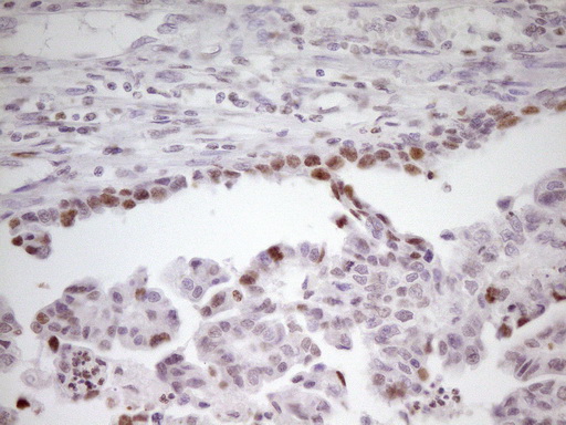 SP110 Antibody - Immunohistochemical staining of paraffin-embedded Adenocarcinoma of Human ovary tissue using anti-SP110 mouse monoclonal antibody. (Heat-induced epitope retrieval by 1 mM EDTA in 10mM Tris, pH8.5, 120C for 3min,