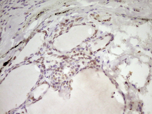 SP110 Antibody - Immunohistochemical staining of paraffin-embedded Human thyroid tissue within the normal limits using anti-SP110 mouse monoclonal antibody. (Heat-induced epitope retrieval by 1 mM EDTA in 10mM Tris, pH8.5, 120C for 3min,