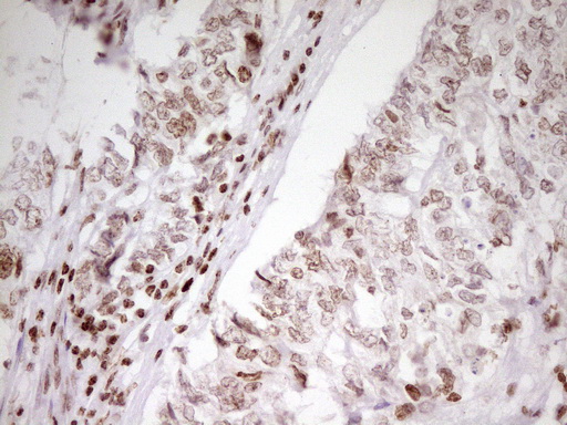 SP110 Antibody - Immunohistochemical staining of paraffin-embedded Adenocarcinoma of Human endometrium tissue using anti-SP110 mouse monoclonal antibody. (Heat-induced epitope retrieval by 1 mM EDTA in 10mM Tris, pH8.5, 120C for 3min,