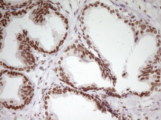 SP110 Antibody - Immunohistochemical staining of paraffin-embedded Carcinoma of Human prostate tissue using anti-SP110 mouse monoclonal antibody. (Heat-induced epitope retrieval by 1 mM EDTA in 10mM Tris, pH8.5, 120C for 3min,