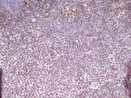 SP110 Antibody - Immunohistochemical staining of paraffin-embedded Human lymphoma tissue using anti-SP110 mouse monoclonal antibody. (Heat-induced epitope retrieval by 1 mM EDTA in 10mM Tris, pH8.5, 120C for 3min,