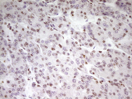 SP110 Antibody - Immunohistochemical staining of paraffin-embedded Carcinoma of Human liver tissue using anti-SP110 mouse monoclonal antibody. (Heat-induced epitope retrieval by 1 mM EDTA in 10mM Tris, pH8.5, 120C for 3min,