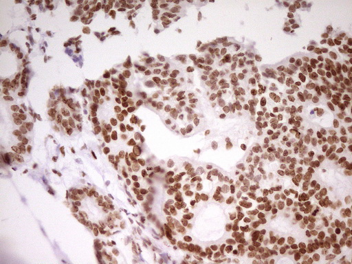 SP110 Antibody - IHC of paraffin-embedded Adenocarcinoma of Human breast tissue using anti-SP110 mouse monoclonal antibody. (Heat-induced epitope retrieval by 1 mM EDTA in 10mM Tris, pH8.5, 120°C for 3min).