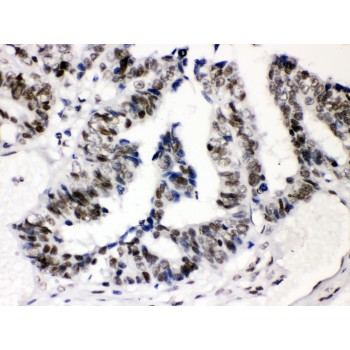 SP3 Antibody - SP3 antibody IHC-paraffin. IHC(P): Human Intestinal Cancer Tissue.