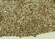 SP3 Antibody - 1:100 staining human breast carcinoma tissue by IHC-P. The sample was formaldehyde fixed and a heat mediated antigen retrieval step in citrate buffer was performed. The sample was then blocked and incubated with the antibody for 1.5 hours at 22°C. An HRP conjugated goat anti-rabbit antibody was used as the secondary.