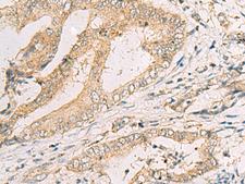 SPACA1 Antibody - Immunohistochemistry of paraffin-embedded Human cervical cancer tissue  using SPACA1 Polyclonal Antibody at dilution of 1:50(×200)