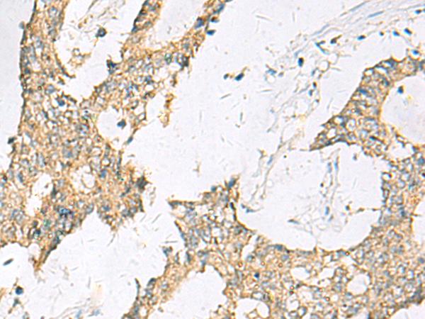 SPACA1 Antibody - Immunohistochemistry of paraffin-embedded Human colorectal cancer tissue  using SPACA1 Polyclonal Antibody at dilution of 1:50(×200)