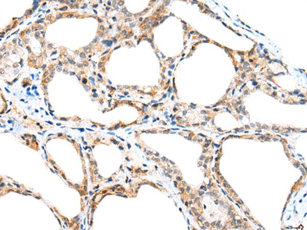 SPACA3 Antibody - Immunohistochemistry of paraffin-embedded Human thyroid cancer tissue  using SPACA3 Polyclonal Antibody at dilution of 1:45(×200)