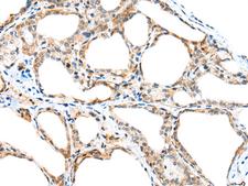 SPACA3 Antibody - Immunohistochemistry of paraffin-embedded Human thyroid cancer tissue  using SPACA3 Polyclonal Antibody at dilution of 1:45(×200)
