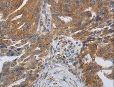 SPAG1 / TPIS Antibody - Immunohistochemistry of paraffin-embedded Human ovarian cancer using SPAG1 Polyclonal Antibody at dilution of 1:25.