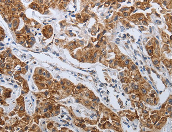 SPAG1 / TPIS Antibody - Immunohistochemistry of paraffin-embedded Human lung cancer using SPAG1 Polyclonal Antibody at dilution of 1:25.