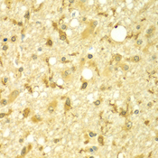 SPAG16 Antibody - Immunohistochemistry of paraffin-embedded human brain cancer tissue.