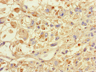SPAG9 Antibody - Immunohistochemistry of paraffin-embedded human melanoma cancer at dilution of 1:100
