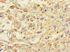SPAG9 Antibody - Immunohistochemistry of paraffin-embedded human melanoma cancer at dilution of 1:100