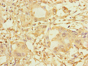 SPAG9 Antibody - Immunohistochemistry of paraffin-embedded human pancreatic cancer at dilution of 1:100