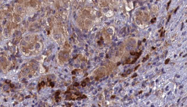 SPAM1 / PH20 Antibody - 1:100 staining human liver carcinoma tissues by IHC-P. The sample was formaldehyde fixed and a heat mediated antigen retrieval step in citrate buffer was performed. The sample was then blocked and incubated with the antibody for 1.5 hours at 22°C. An HRP conjugated goat anti-rabbit antibody was used as the secondary.