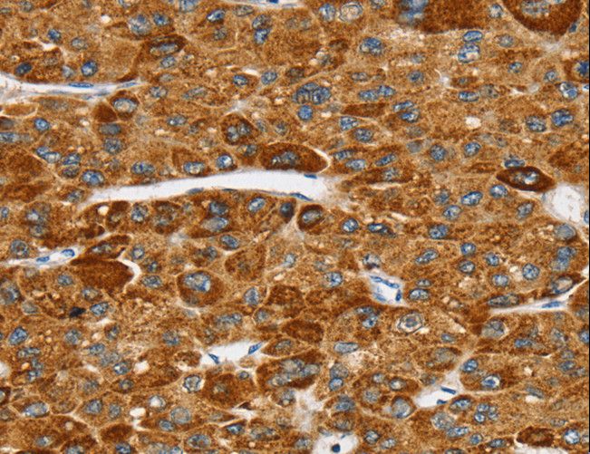 SPARCL1 / Hevin Antibody - Immunohistochemistry of paraffin-embedded Human breast cancer using SPARCL1 Polyclonal Antibody at dilution of 1:30.