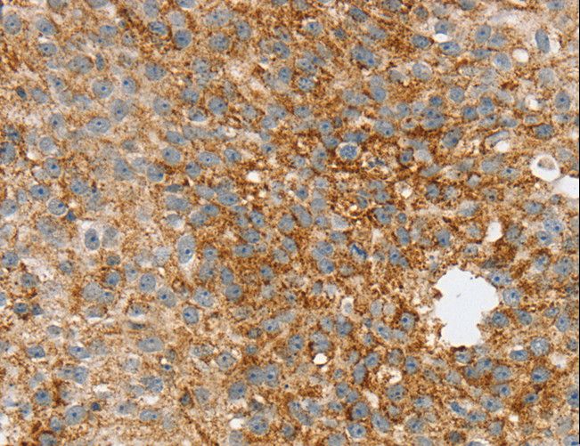 SPARCL1 / Hevin Antibody - Immunohistochemistry of paraffin-embedded Human breast cancer using SPARCL1 Polyclonal Antibody at dilution of 1:30.