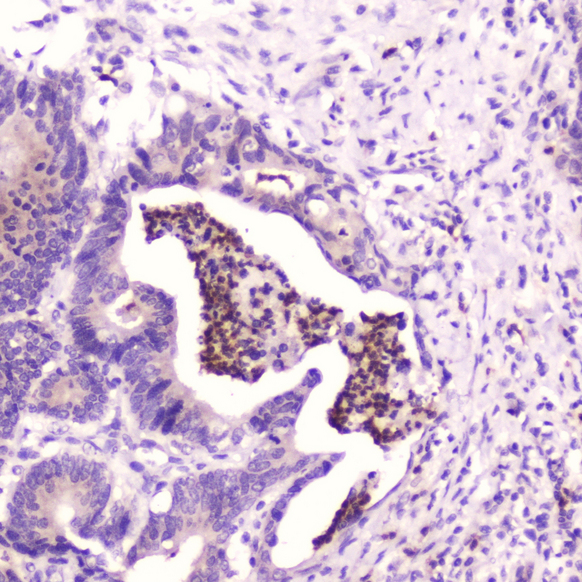 SPARCL1 / Hevin Antibody - IHC analysis of SPARCL1 using anti-SPARCL1 antibody. SPARCL1 was detected in paraffin-embedded section of human colon cancer tissue. Heat mediated antigen retrieval was performed in citrate buffer (pH6, epitope retrieval solution) for 20 mins. The tissue section was blocked with 10% goat serum. The tissue section was then incubated with 2?g/ml rabbit anti-SPARCL1 Antibody overnight at 4?C. Biotinylated goat anti-rabbit IgG was used as secondary antibody and incubated for 30 minutes at 37?C. The tissue section was developed using Strepavidin-Biotin-Complex (SABC) with DAB as the chromogen.