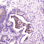 SPARCL1 / Hevin Antibody - IHC testing of FFPE human colon cancer with SPARCL1 antibody at 2ug/ml. HIER: boil tissue sections in pH6, 10mM citrate buffer, for 10-20 min followed by cooling at RT for 20 min.