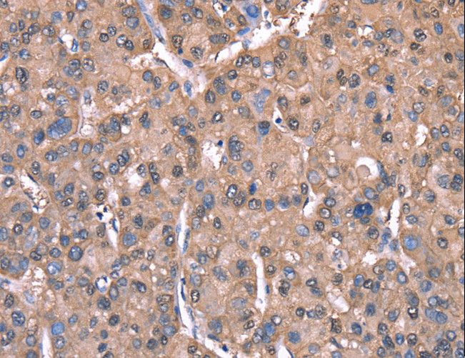 Spastin Antibody - Immunohistochemistry of paraffin-embedded Human liver cancer using SPAST Polyclonal Antibody at dilution of 1:40.