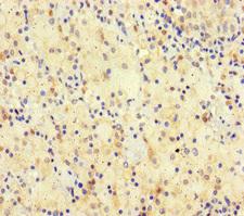 SPATA16 / NYD-SP12 Antibody - Immunohistochemistry of paraffin-embedded human lung cancer at dilution of 1:100