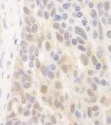 SPATA2 Antibody - Detection of Human SPATA2 by Immunohistochemistry. Sample: FFPE section of human breast carcinoma. Antibody: Affinity purified rabbit anti-SPATA2 used at a dilution of 1:250.