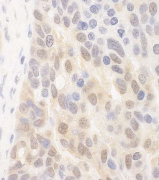 SPATA2 Antibody - Detection of Human SPATA2 by Immunohistochemistry. Sample: FFPE section of human breast carcinoma. Antibody: Affinity purified rabbit anti-SPATA2 used at a dilution of 1:250.
